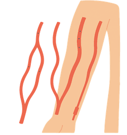 Gestão do Acesso Vascular para hemodiálise