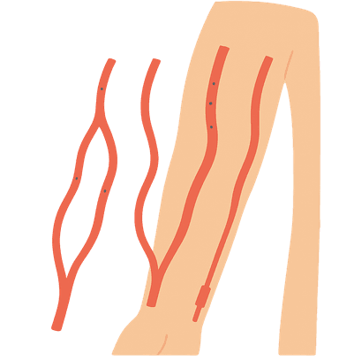 Gestão do Acesso Vascular para hemodiálise
